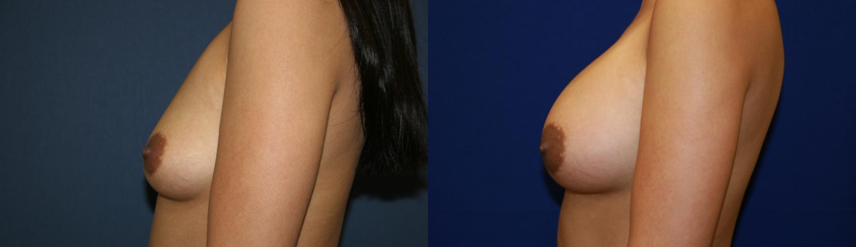 Breast Augmentation Case 52 Before & After View #3 | San Jose & Palo Alto, CA | Daryl K. Hoffman, MD