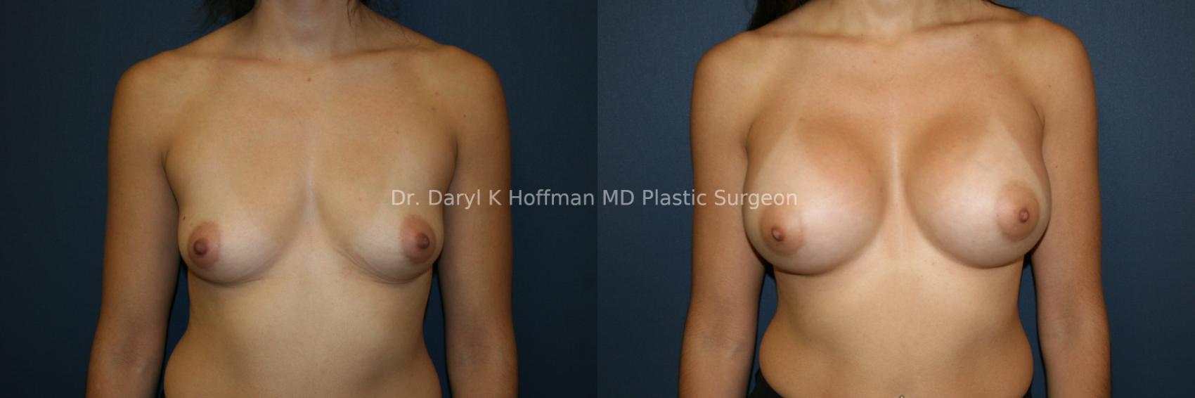 Breast Augmentation Case 53 Before & After View #1 | San Jose & Palo Alto, CA | Daryl K. Hoffman, MD