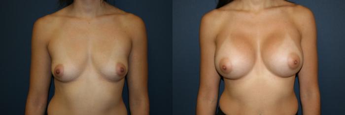 Breast Augmentation Case 53 Before & After View #1 | San Jose & Palo Alto, CA | Daryl K. Hoffman, MD