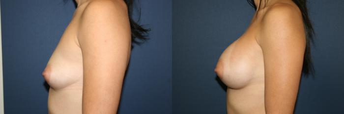 Breast Augmentation Case 53 Before & After View #2 | San Jose & Palo Alto, CA | Daryl K. Hoffman, MD