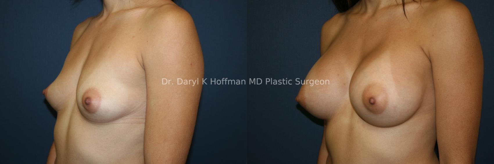 Breast Augmentation Case 53 Before & After View #3 | San Jose & Palo Alto, CA | Daryl K. Hoffman, MD