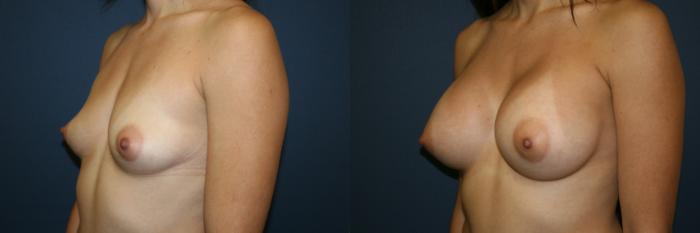 Breast Augmentation Case 53 Before & After View #3 | San Jose & Palo Alto, CA | Daryl K. Hoffman, MD
