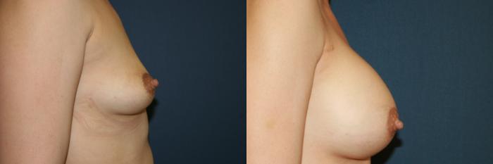 Breast Augmentation Case 54 Before & After View #2 | San Jose & Palo Alto, CA | Daryl K. Hoffman, MD