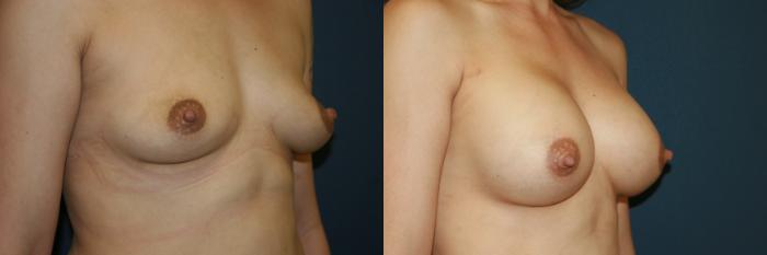 Breast Augmentation Case 54 Before & After View #3 | San Jose & Palo Alto, CA | Daryl K. Hoffman, MD