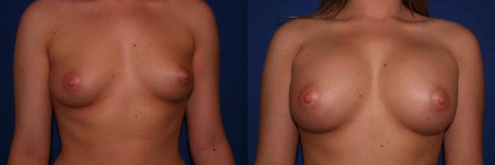 Breast Augmentation Case 6 Before & After View #1 | San Jose & Palo Alto, CA | Daryl K. Hoffman, MD