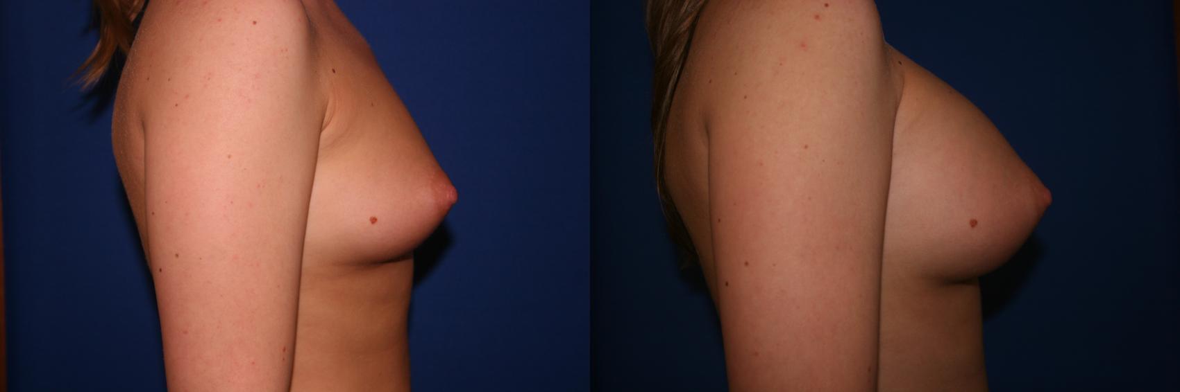 Breast Augmentation Case 6 Before & After View #2 | San Jose & Palo Alto, CA | Daryl K. Hoffman, MD
