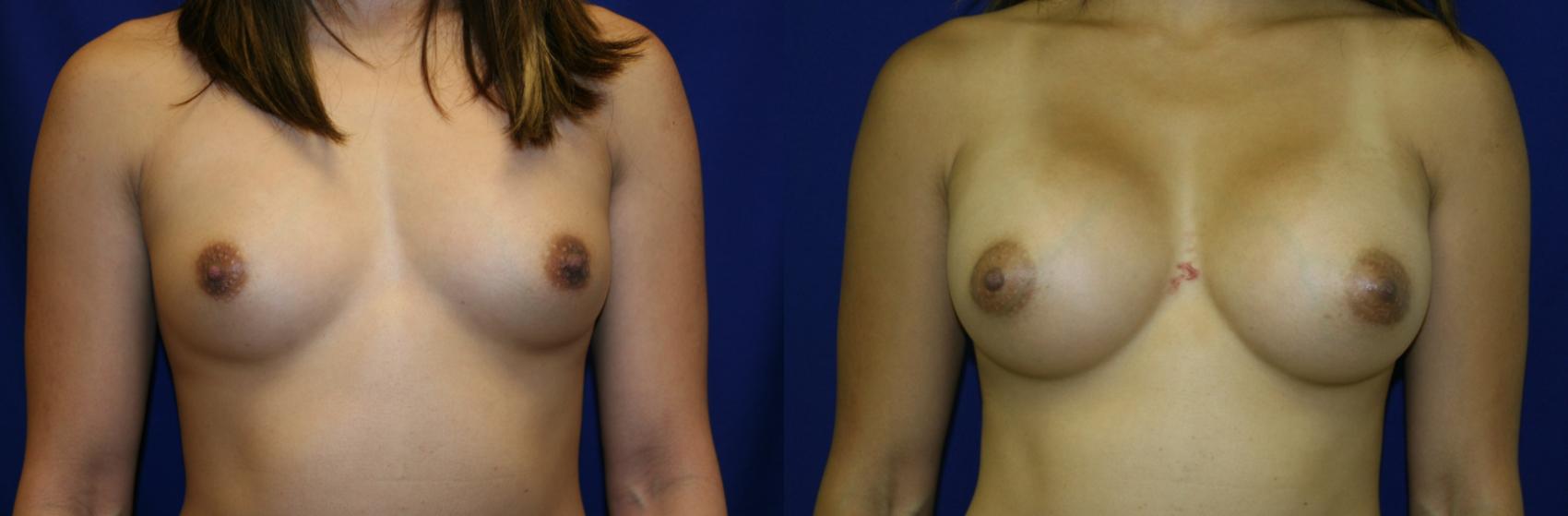 Breast Augmentation Case 61 Before & After View #1 | San Jose & Palo Alto, CA | Daryl K. Hoffman, MD