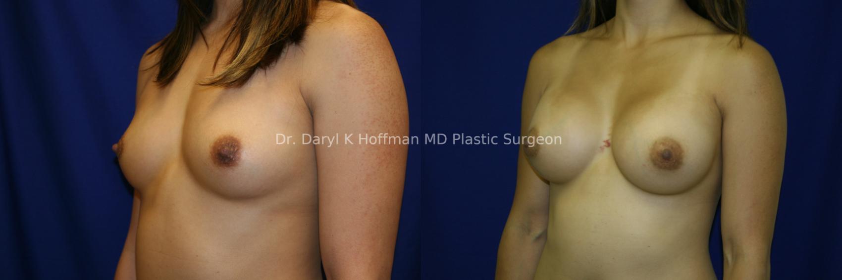 Breast Augmentation Case 61 Before & After View #2 | San Jose & Palo Alto, CA | Daryl K. Hoffman, MD