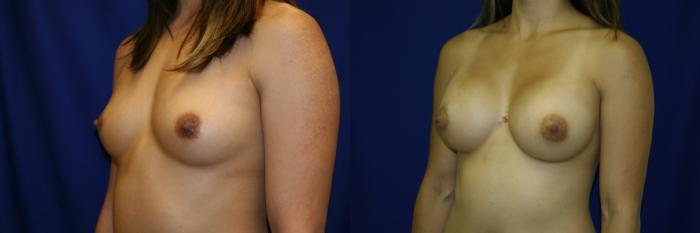 Breast Augmentation Case 61 Before & After View #2 | San Jose & Palo Alto, CA | Daryl K. Hoffman, MD