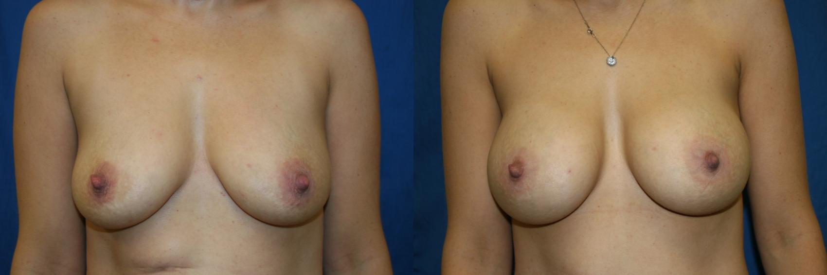 Breast Augmentation Case 62 Before & After View #1 | San Jose & Palo Alto, CA | Daryl K. Hoffman, MD