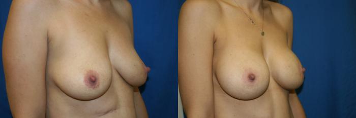 Breast Augmentation Case 62 Before & After View #2 | San Jose & Palo Alto, CA | Daryl K. Hoffman, MD