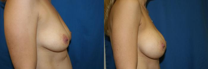 Breast Augmentation Case 62 Before & After View #3 | San Jose & Palo Alto, CA | Daryl K. Hoffman, MD