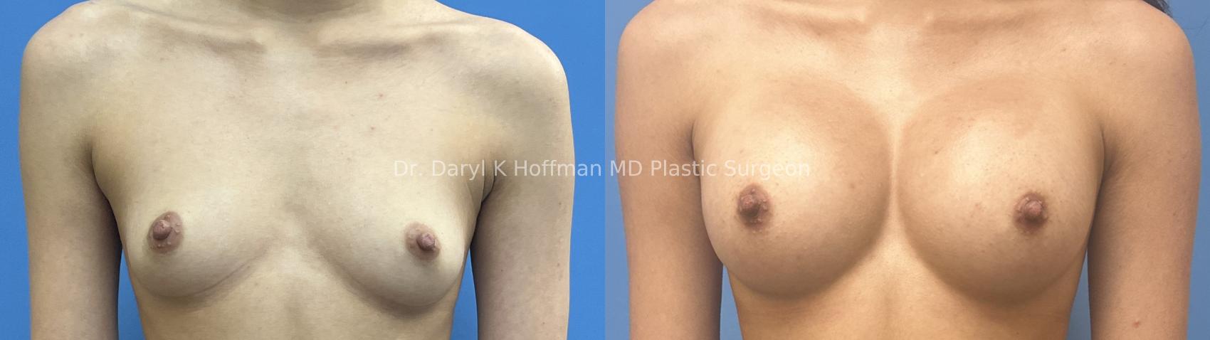 Breast Augmentation Case 65 Before & After Front | San Jose & Palo Alto, CA | Daryl K. Hoffman, MD