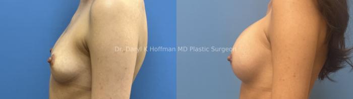 Breast Augmentation Case 65 Before & After Left Side | San Jose & Palo Alto, CA | Daryl K. Hoffman, MD