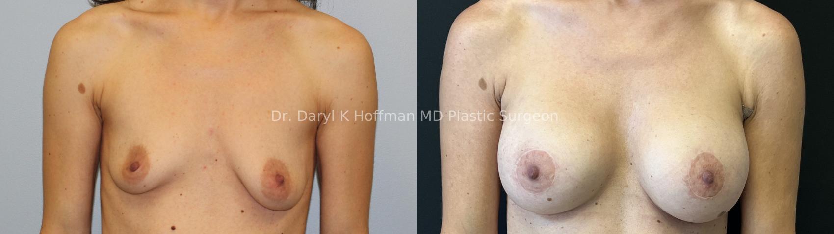 Breast Augmentation Case 68 Before & After Front | San Jose & Palo Alto, CA | Daryl K. Hoffman, MD