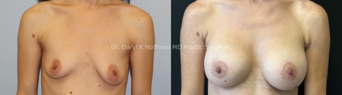 Breast Augmentation Case 68 Before & After Front | San Jose & Palo Alto, CA | Daryl K. Hoffman, MD