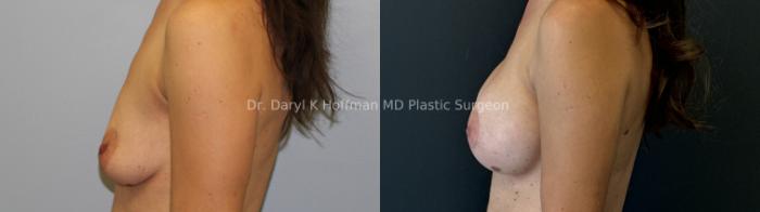 Breast Augmentation Case 68 Before & After Left Side | San Jose & Palo Alto, CA | Daryl K. Hoffman, MD