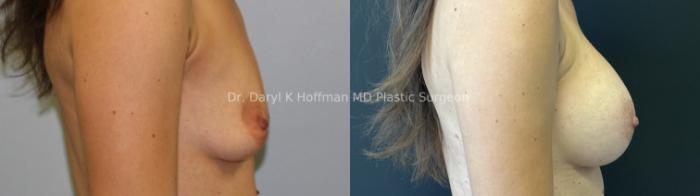 Breast Augmentation Case 68 Before & After Right Side | San Jose & Palo Alto, CA | Daryl K. Hoffman, MD