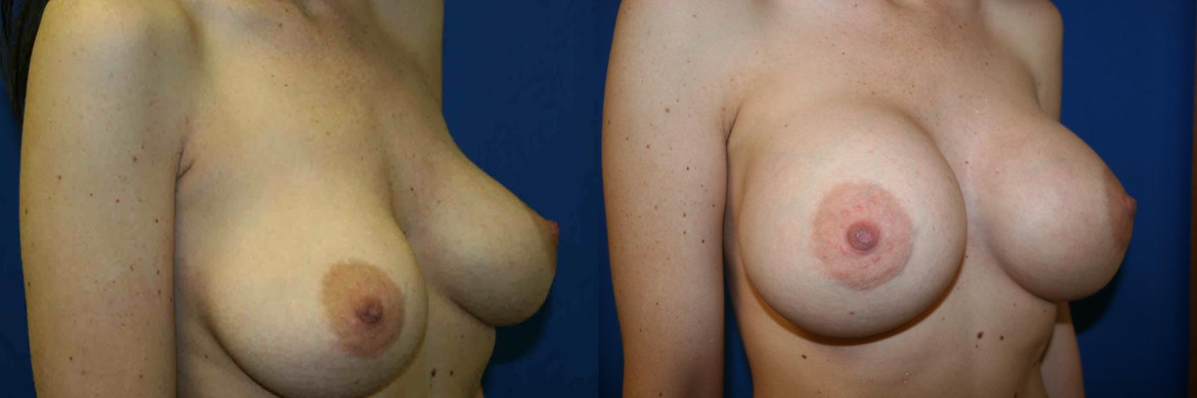 Breast Augmentation Case 7 Before & After View #1 | San Jose & Palo Alto, CA | Daryl K. Hoffman, MD
