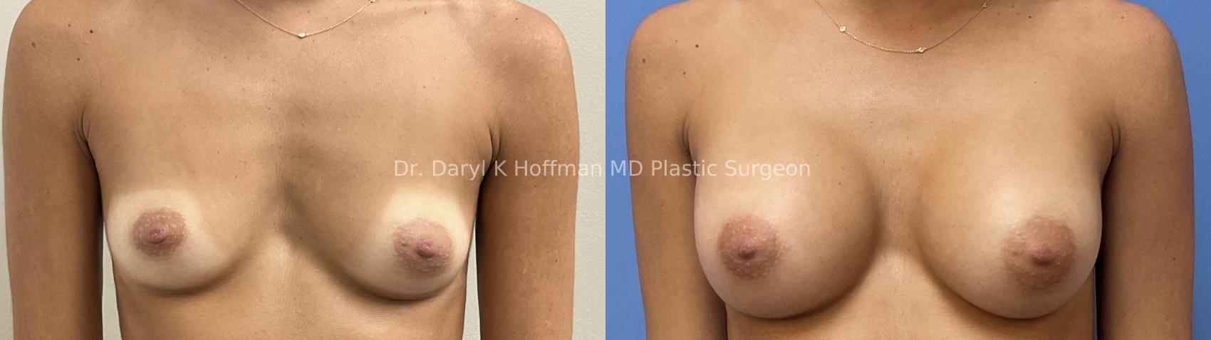 Breast Augmentation Case 77 Before & After Front | San Jose & Palo Alto, CA | Daryl K. Hoffman, MD