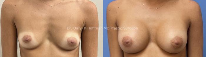 Breast Augmentation Case 77 Before & After Front | San Jose & Palo Alto, CA | Daryl K. Hoffman, MD