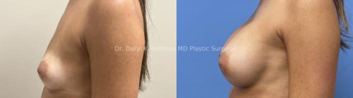 Breast Augmentation Case 77 Before & After Left Side | San Jose & Palo Alto, CA | Daryl K. Hoffman, MD