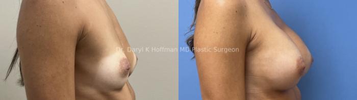 Breast Augmentation Case 77 Before & After Right Side | San Jose & Palo Alto, CA | Daryl K. Hoffman, MD