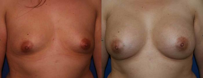 Breast Augmentation Case 8 Before & After View #1 | San Jose & Palo Alto, CA | Daryl K. Hoffman, MD