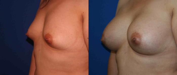 Breast Augmentation Case 8 Before & After View #2 | San Jose & Palo Alto, CA | Daryl K. Hoffman, MD