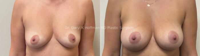 Breast Augmentation Case 80 Before & After Front | San Jose & Palo Alto, CA | Daryl K. Hoffman, MD