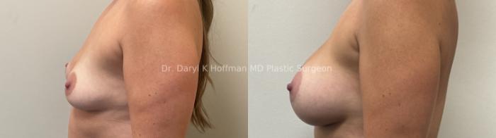 Breast Augmentation Case 80 Before & After Left Side | San Jose & Palo Alto, CA | Daryl K. Hoffman, MD