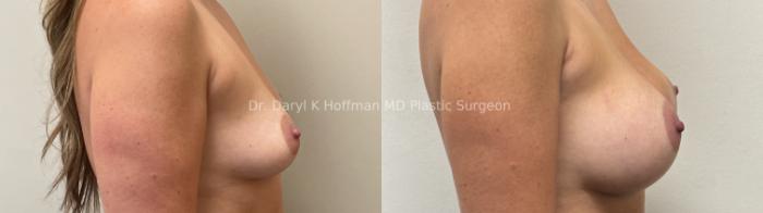 Breast Augmentation Case 80 Before & After Right Side | San Jose & Palo Alto, CA | Daryl K. Hoffman, MD