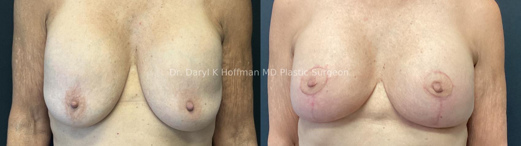 Breast Augmentation Case 85 Before & After Front | San Jose & Palo Alto, CA | Daryl K. Hoffman, MD