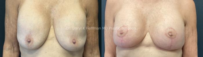 Implant Exchange  Case 85 Before & After Front | San Jose & Palo Alto, CA | Daryl K. Hoffman, MD