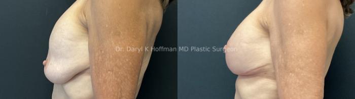 Breast Augmentation Case 85 Before & After Left Side | San Jose & Palo Alto, CA | Daryl K. Hoffman, MD