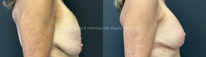 Breast Augmentation Case 85 Before & After Right Side | San Jose & Palo Alto, CA | Daryl K. Hoffman, MD