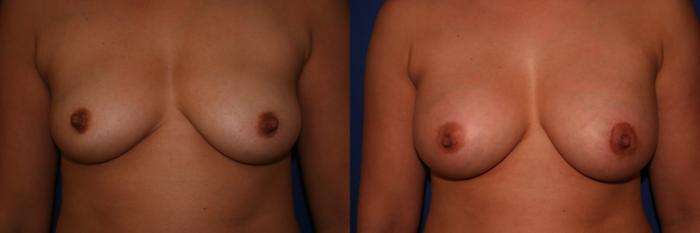 Breast Augmentation Case 9 Before & After View #1 | San Jose & Palo Alto, CA | Daryl K. Hoffman, MD