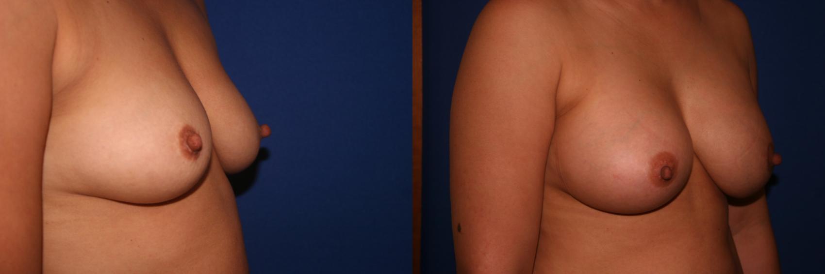 Breast Augmentation Case 9 Before & After View #2 | San Jose & Palo Alto, CA | Daryl K. Hoffman, MD
