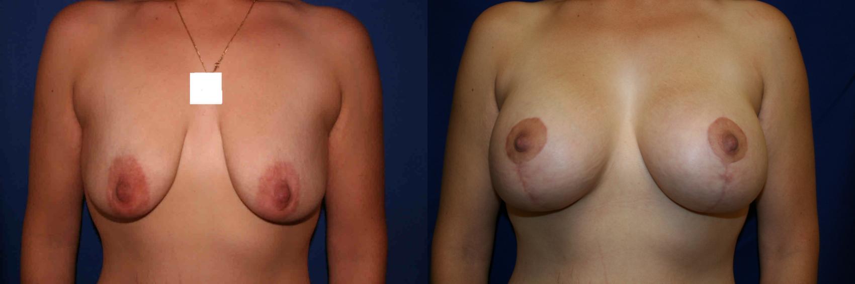 Breast Lift Case 16 Before & After View #1 | San Jose & Palo Alto, CA | Daryl K. Hoffman, MD