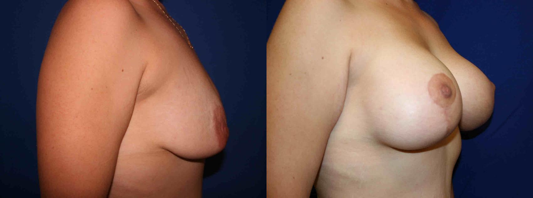 Breast Lift Case 16 Before & After View #2 | San Jose & Palo Alto, CA | Daryl K. Hoffman, MD