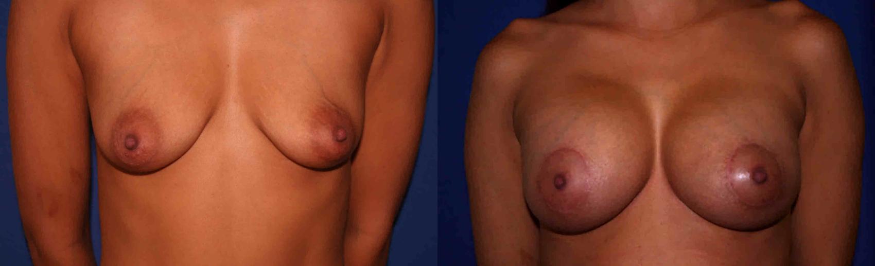 Breast Lift Case 17 Before & After View #1 | San Jose & Palo Alto, CA | Daryl K. Hoffman, MD