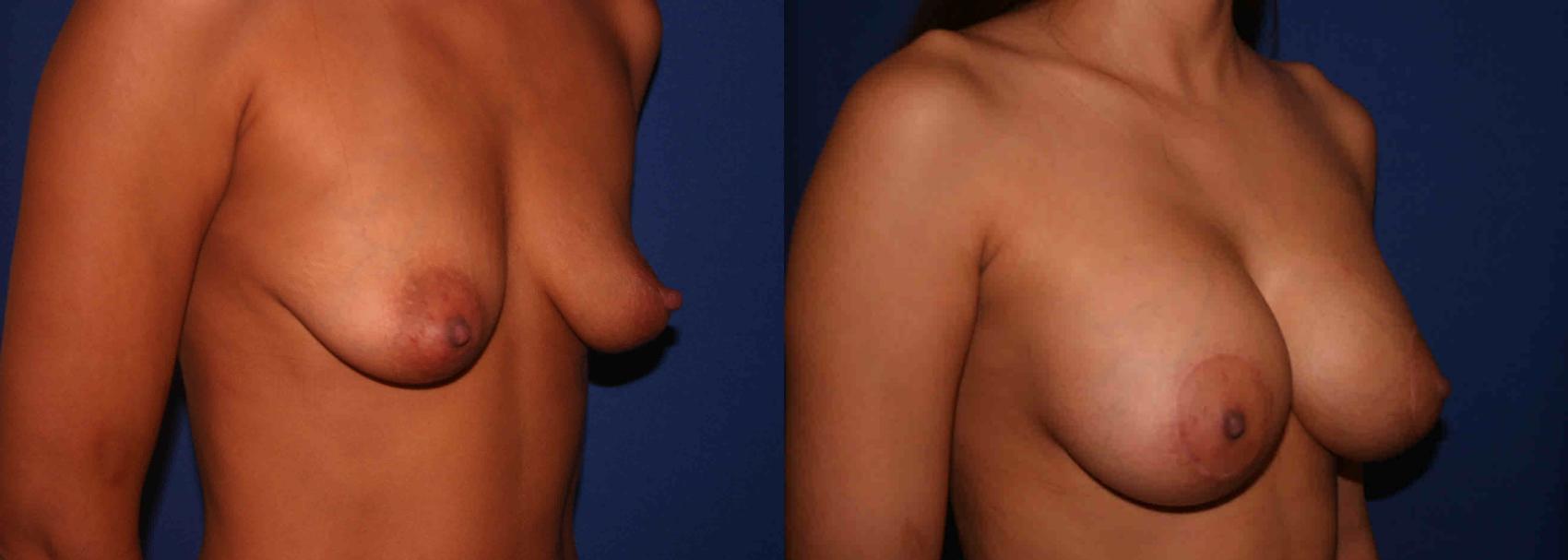 Breast Lift Case 17 Before & After View #2 | San Jose & Palo Alto, CA | Daryl K. Hoffman, MD