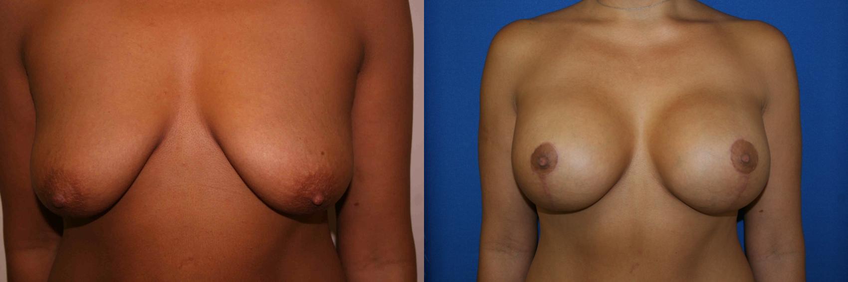 Breast Lift Case 18 Before & After View #1 | San Jose & Palo Alto, CA | Daryl K. Hoffman, MD