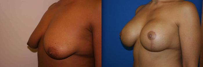 Breast Lift Case 18 Before & After View #2 | San Jose & Palo Alto, CA | Daryl K. Hoffman, MD
