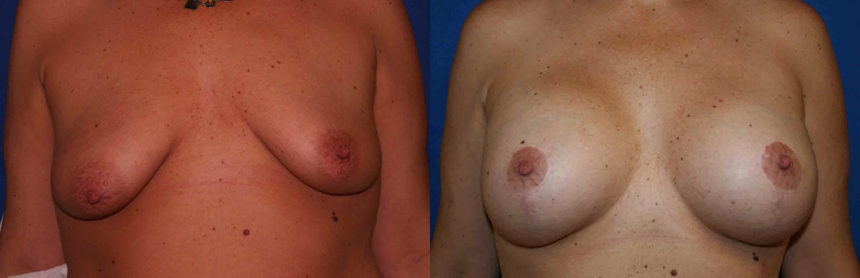 Breast Lift Case 19 Before & After View #1 | San Jose & Palo Alto, CA | Daryl K. Hoffman, MD