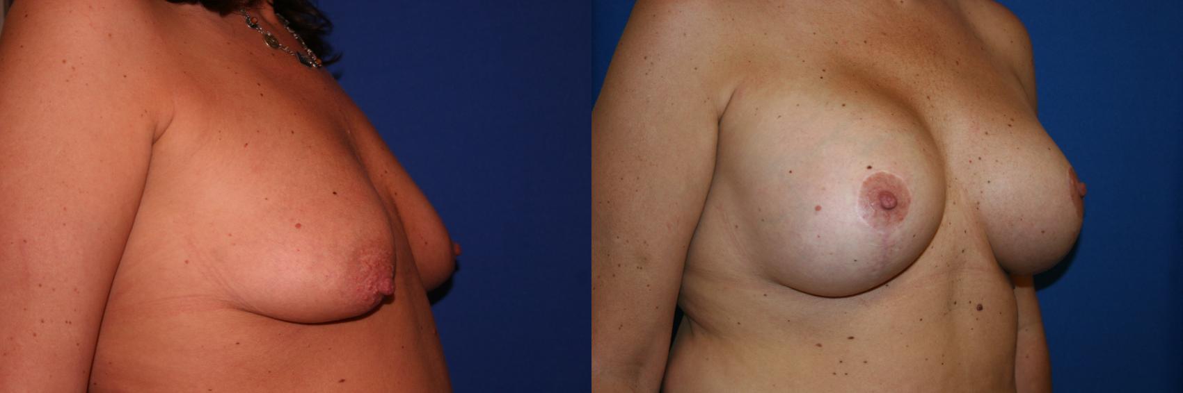 Breast Lift Case 19 Before & After View #2 | San Jose & Palo Alto, CA | Daryl K. Hoffman, MD