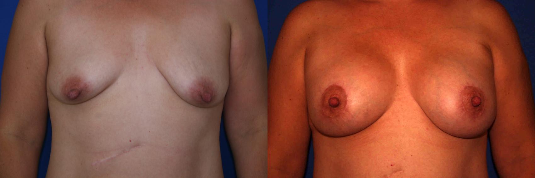 Breast Lift Case 20 Before & After View #1 | San Jose & Palo Alto, CA | Daryl K. Hoffman, MD
