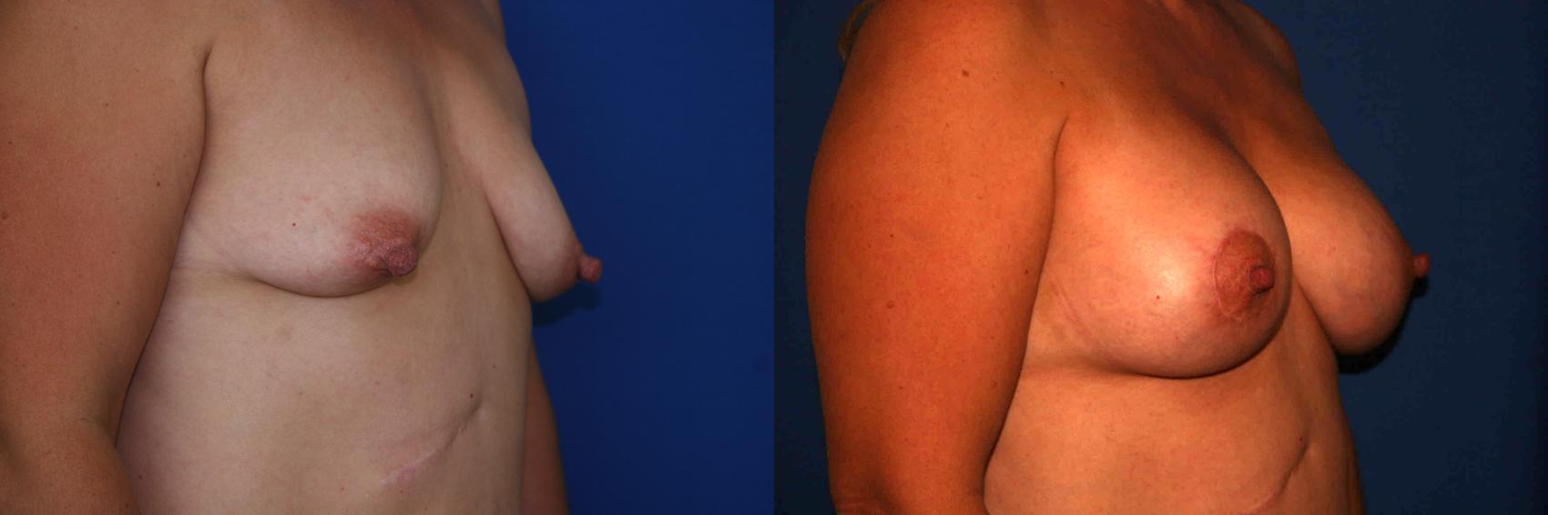 Breast Lift Case 20 Before & After View #2 | San Jose & Palo Alto, CA | Daryl K. Hoffman, MD
