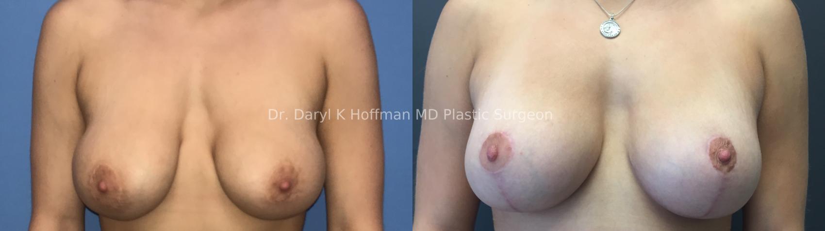 Breast Lift Case 73 Before & After Front | San Jose & Palo Alto, CA | Daryl K. Hoffman, MD