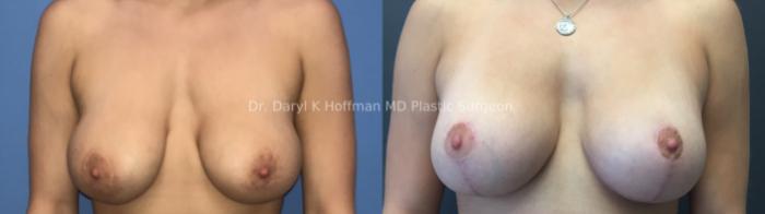 Breast Lift Case 73 Before & After Front | San Jose & Palo Alto, CA | Daryl K. Hoffman, MD